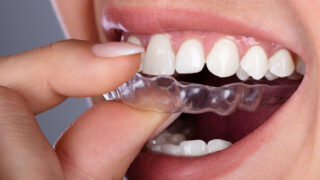 护齿套-治疗磨牙和睡眠磨牙症