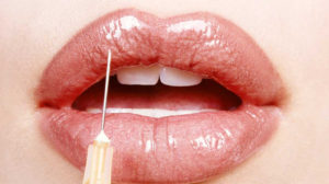 唇部注射-关于肉毒杆菌和填充物的文章