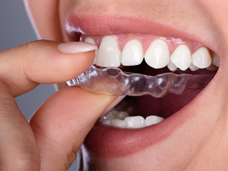 护齿器-预防磨牙和磨牙症的治疗方法