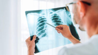 肺癌-症状和治疗