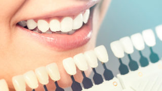 牙科美容-牙齿美白，瓷镶面，种植体