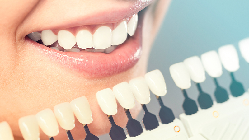 牙科美容-牙齿美白，瓷饰面，植体